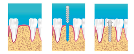 Implants dentaires Athis-Mons